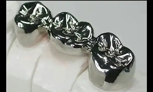Full Cast Metal Crowns Deliver Maximum Strength for Heavy Occlusion Applications